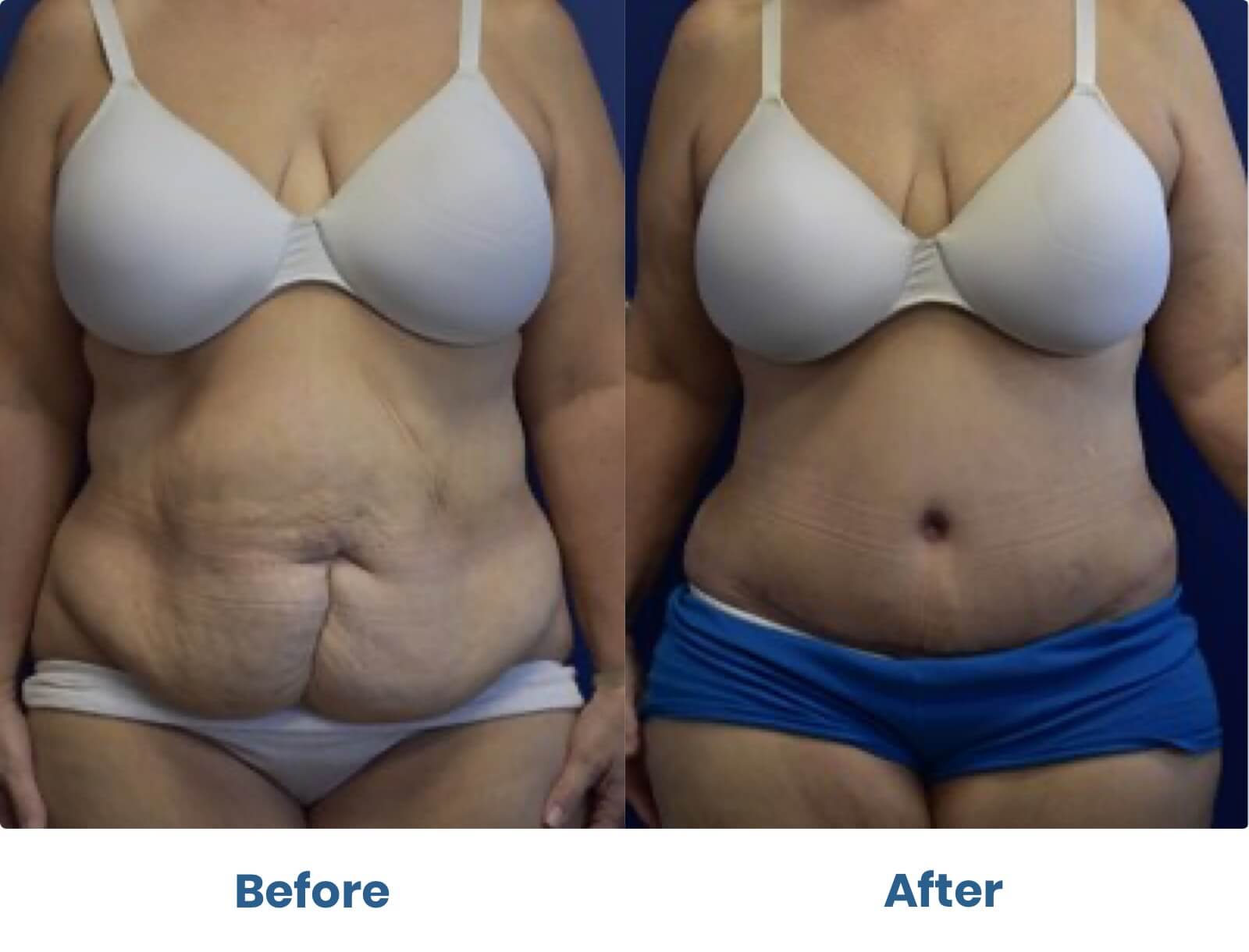Before and after photos of tummy tuck