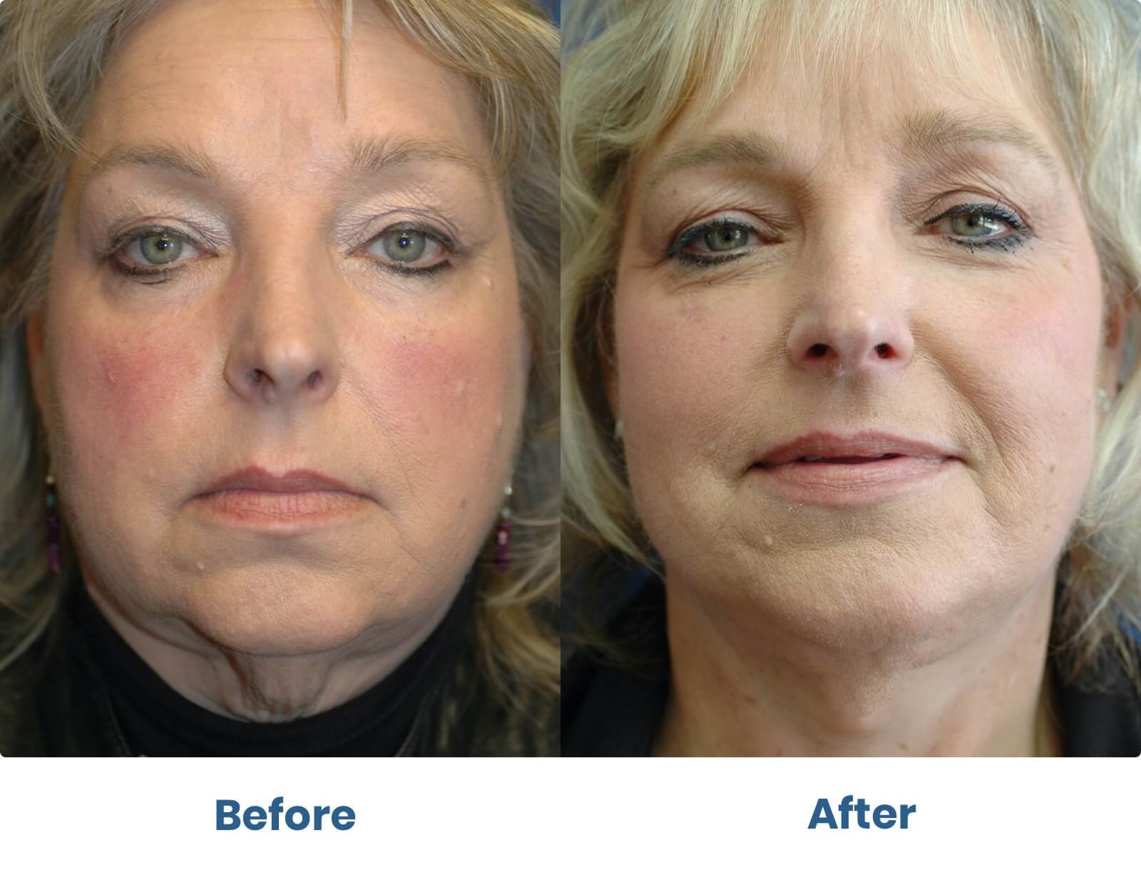 Before and after photos of facial treatments