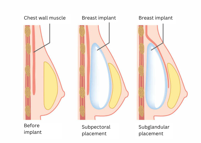 diagram showing before and after of a subpectoral and subglandular breast implants