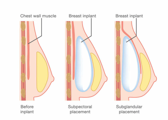 diagram before and after breast augmentation