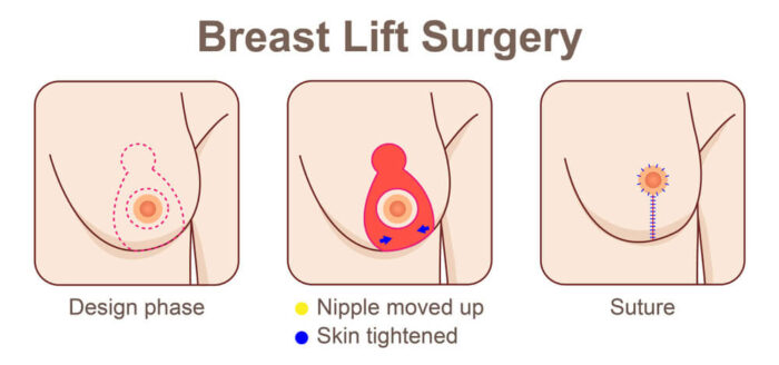 diagram before and after breast lift