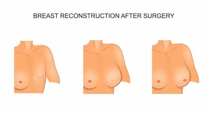 diagram before and after breast reconstruction