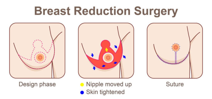 diagram before and after breast reduction