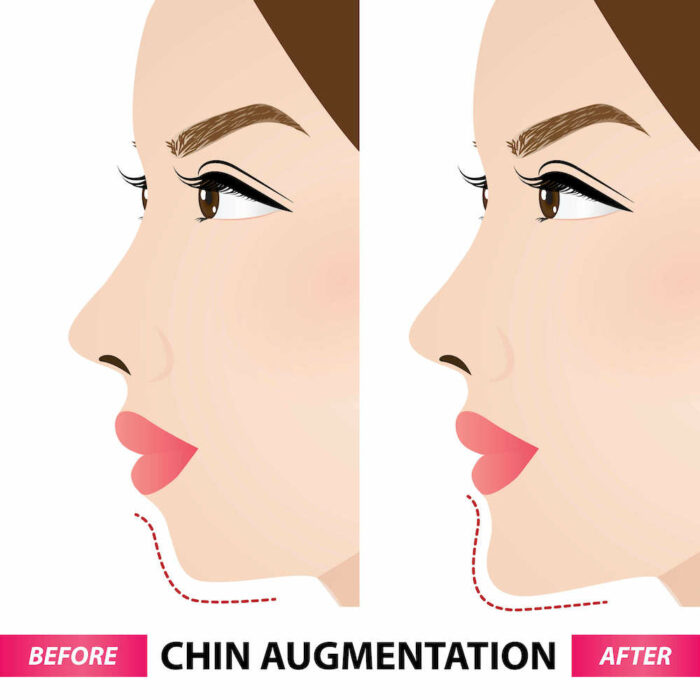 diagram before and after chin augmentation