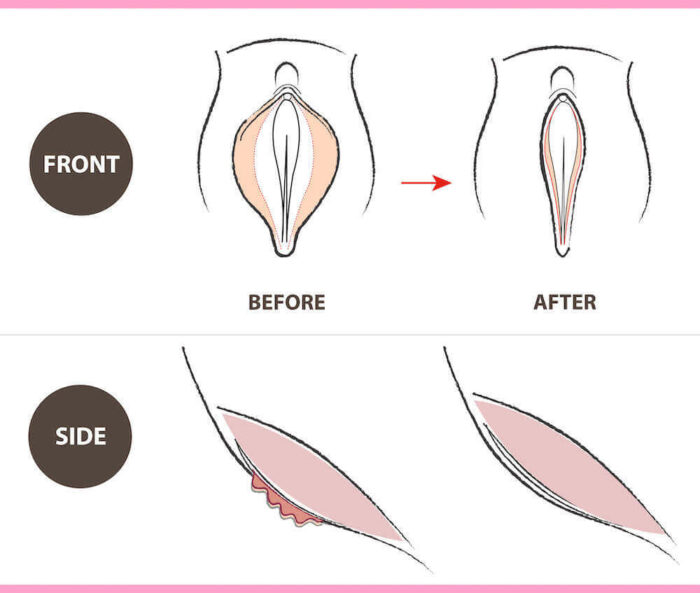 diagram before and after labiaplasty