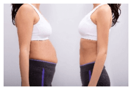 Before and after liposuction woman