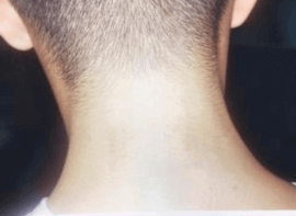 Back of a man's neck showing removal of tattoo by Pico laser