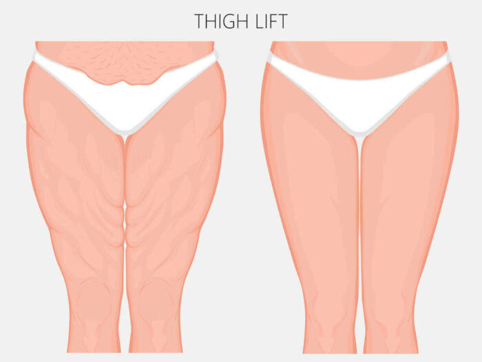 diagram before and after thigh lift