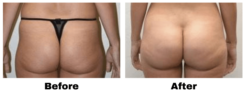 butt augmentation before and over